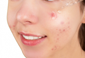 Best Skincare Products - Acne Treatments