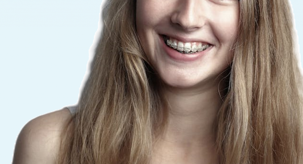 Clear Braces and Invisible Dental Braces
