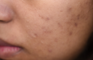 Acne most common skin condition